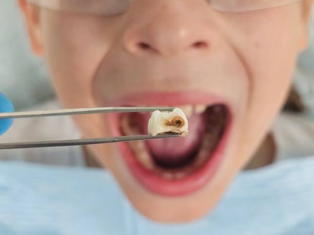 Best Emergency Wisdom Teeth Removal in Greenwich, OH